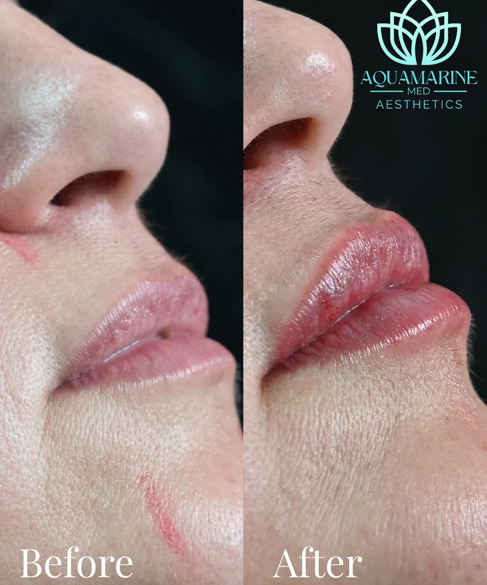 Before and after lip augmentation