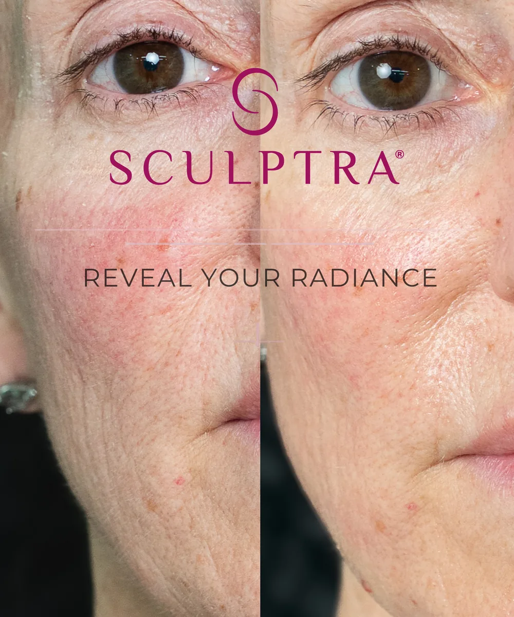 Before and after Sculptra treatment